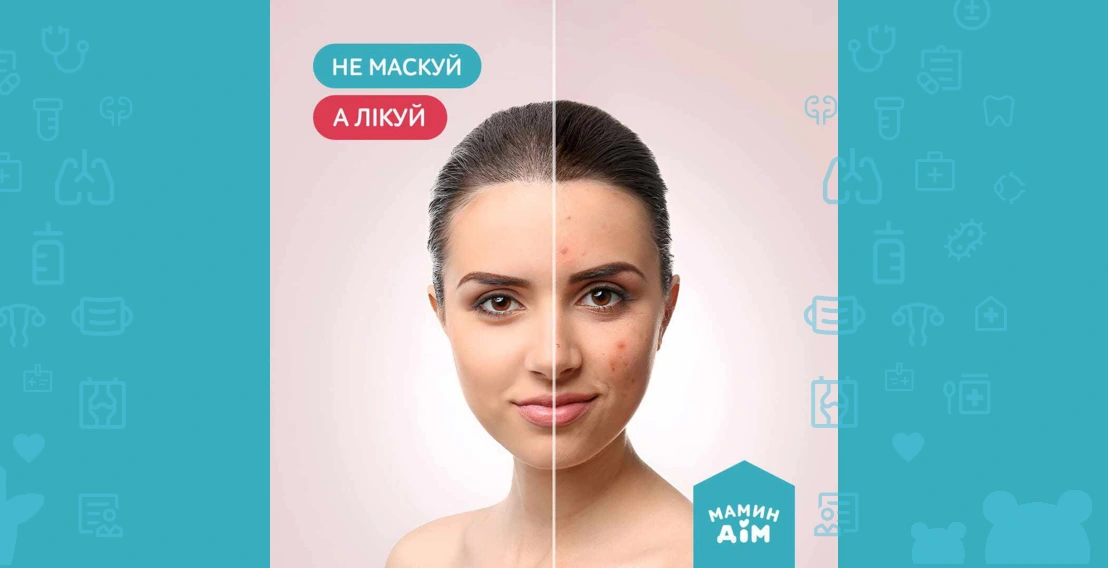 Do not mask, but treat "acne" 👧