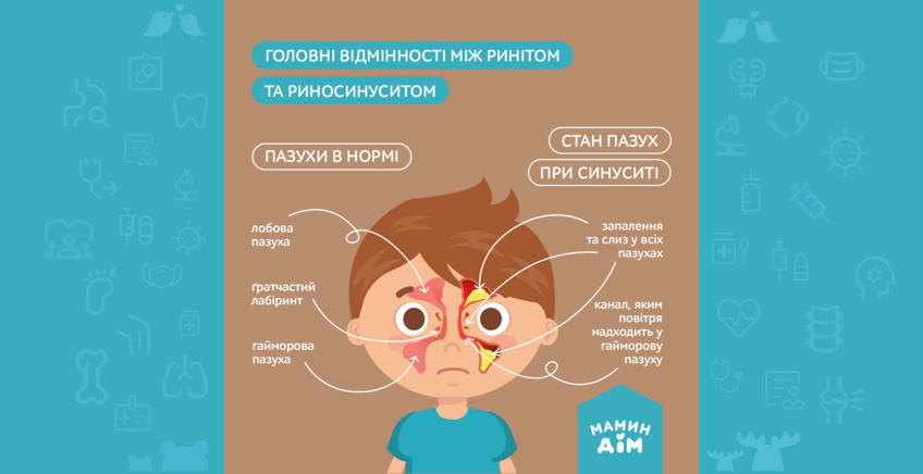 The main differences between rhinitis and rhinosinusitis