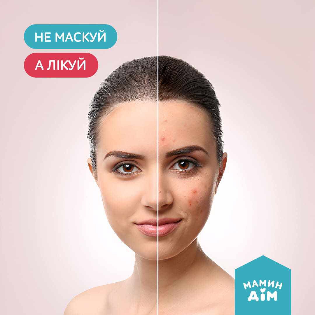 Do not mask, but treat "acne" 👧