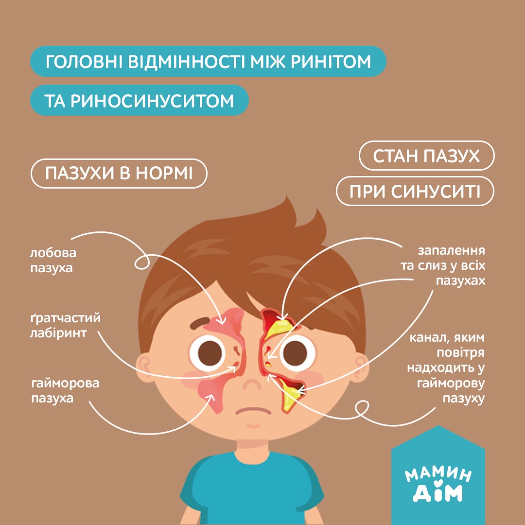 The main differences between rhinitis and rhinosinusitis